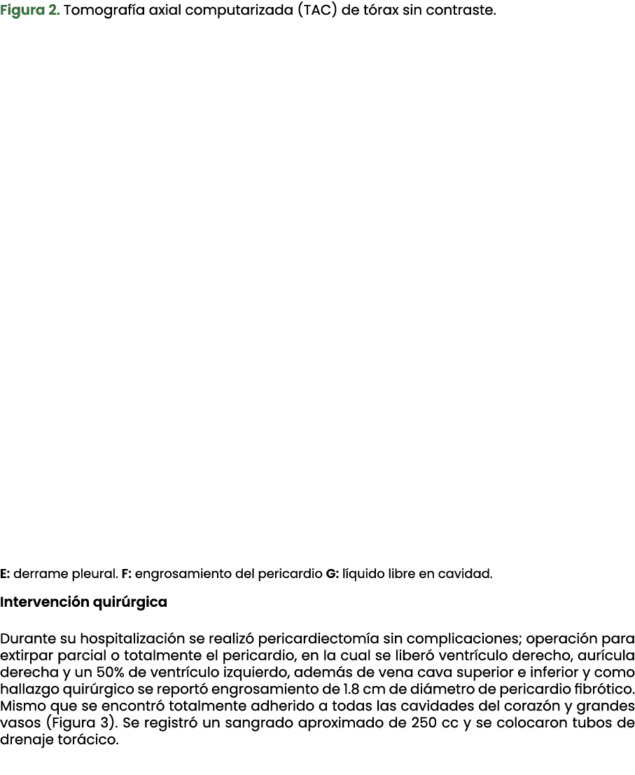 Figura 2. Tomograf a axial computarizada (TAC) de t rax sin contraste. E: derrame pleural. F: engrosamiento del peric...